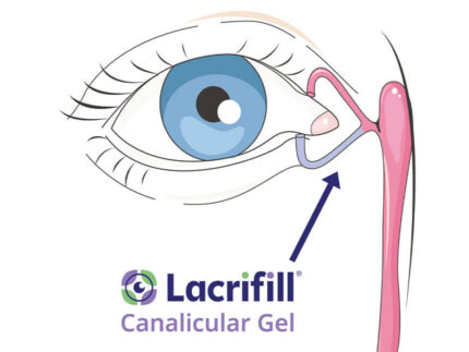 Punctal Plugs for Dry Eyes | London UK | Dry Eye Centre